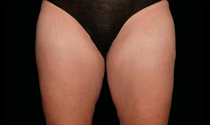 Thighs after CoolSculpting Body Contouring fat loss Treatment in Montreal