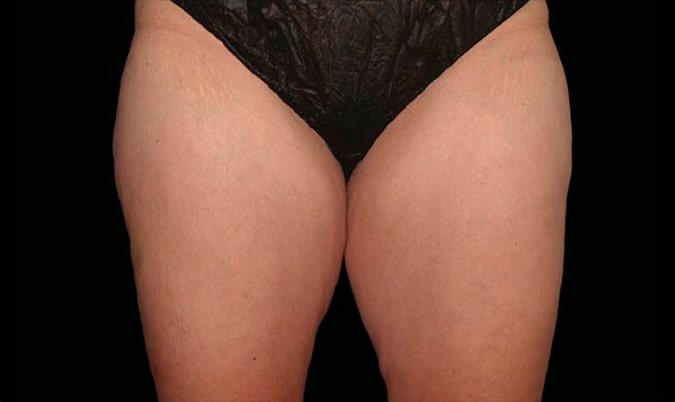 Thighs Before CoolSculpting Body Contouring fat loss Treatment in Montreal