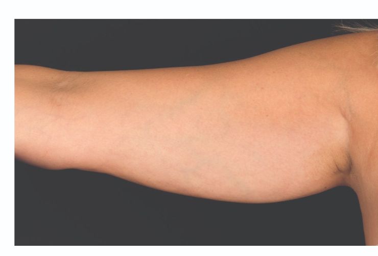 Arm fat Before CoolSculpting Body Contouring fat loss Treatment in Montreal