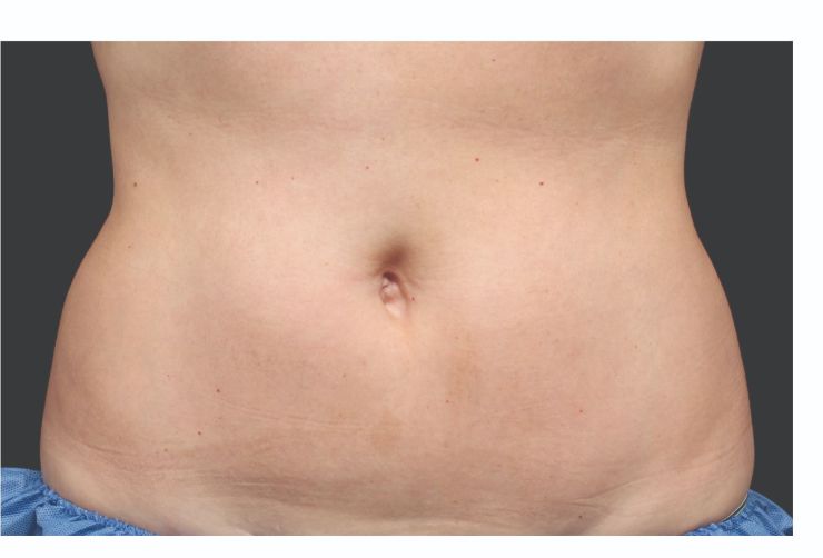 Belly fat after CoolSculpting Body Contouring fat loss Treatment in Montreal