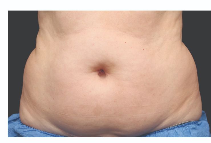 Belly fat Before CoolSculpting Body Contouring fat loss Treatment in Montreal