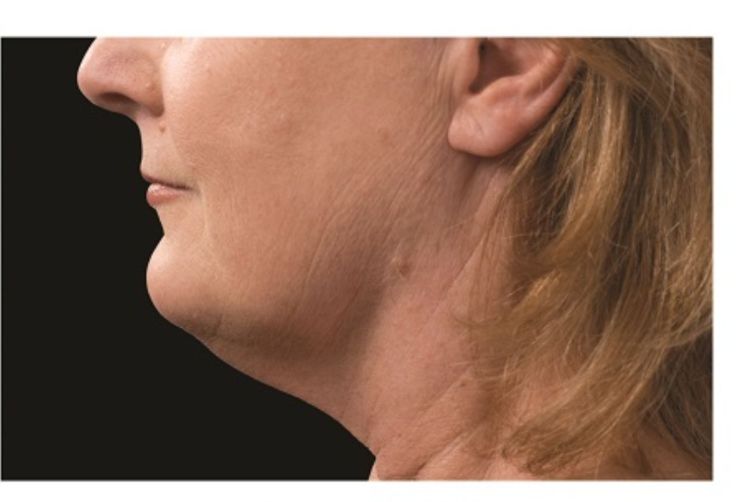 Sagging double chin After CoolSculpting Body Contouring fat loss Treatment in Montreal