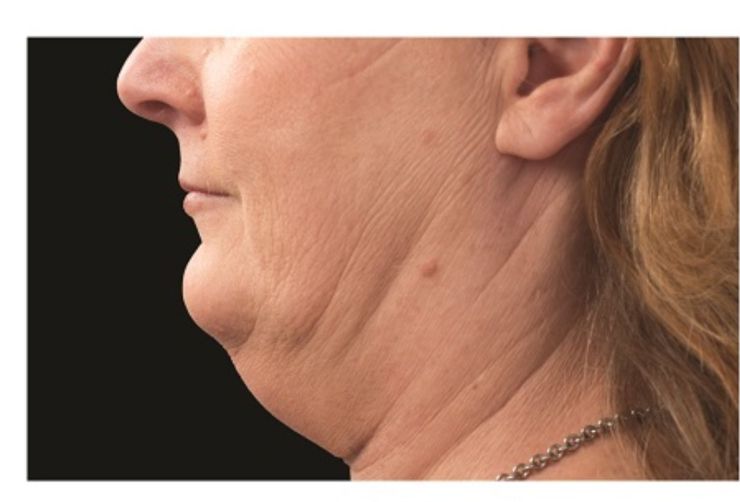 Sagging Double chin Before CoolSculpting Body Contouring fat loss Treatment in Montreal
