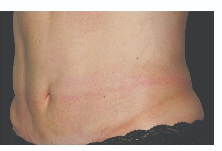 Stubborn Belly fat After CoolSculpting Body Contouring fat loss Treatment in Montreal