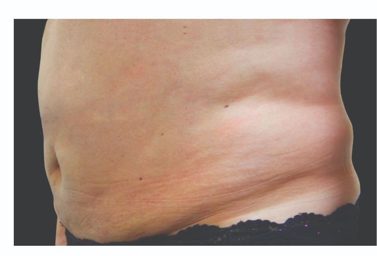 Stubborn Belly fat Before CoolSculpting Body Contouring fat loss Treatment in Montreal