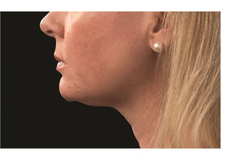 Sagging double chin After CoolSculpting Body Contouring fat loss Treatment in Montreal