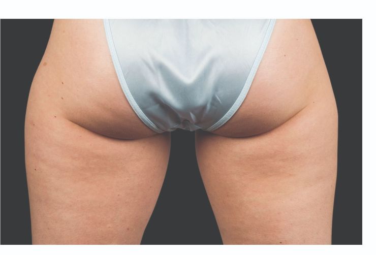 Glutes and thighs After CoolSculpting Body Contouring fat loss Treatment in Montreal