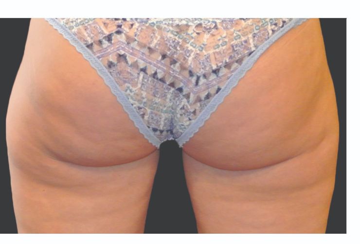 Cellulite buttoks and thighs After CoolSculpting Body Contouring fat loss Treatment in Montreal