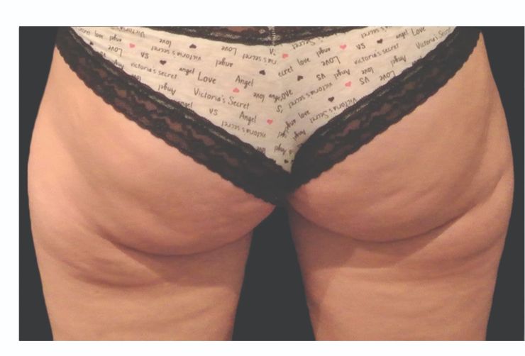 Cellulite buttocks and thighs Before CoolSculpting Body Contouring fat loss Treatment in Montreal