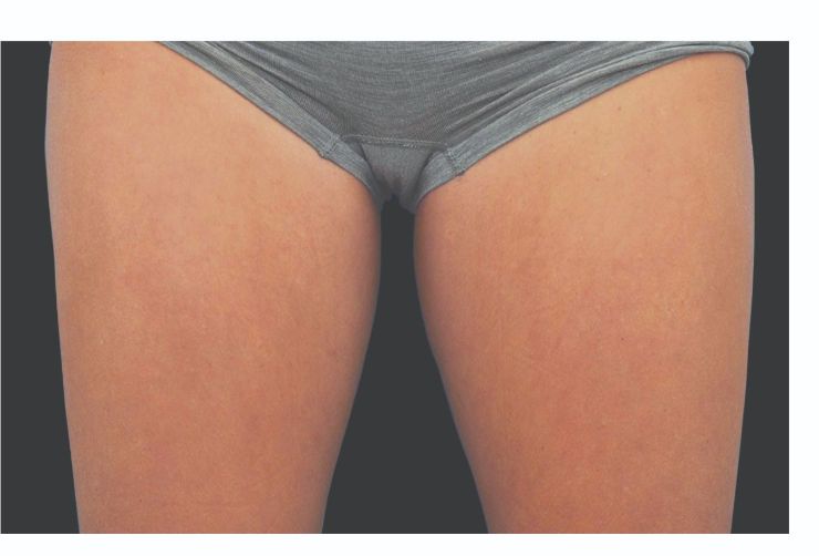 Thighs After CoolSculpting Body Contouring fat loss Treatment in Montreal