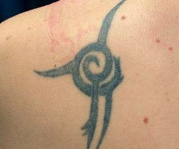 Before Fotona Laser Skin tattoo removal - Montreal