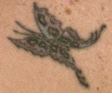 Before Fotona Laser Skin tattoo removal - Montreal