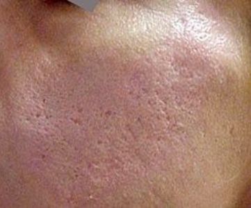 Acne Fotona Laser Skin Treatment for acne and acne scars - Montreal