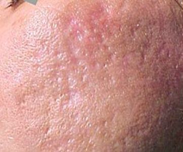 Before Fotona Laser Skin Treatment for acne and acne scars - Montreal