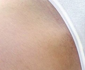 After Fotona Laser Skin Treatment for bikini hair removal - Montreal