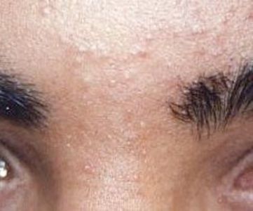 After Fotona Laser Skin Treatment for facial hair removal - Montreal