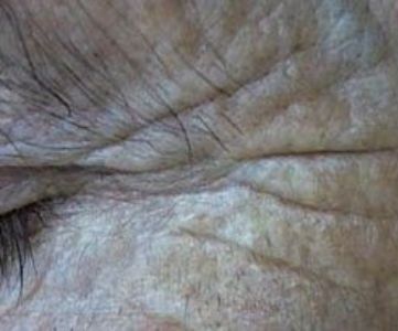 Before Fotona Laser Skin Treatment for eye wrinkles - Montreal