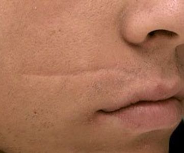 Before Fotona Laser Skin Treatment for scar removal - Montreal