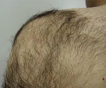 Before Fotona Laser Skin Treatment for body hair removal - Montreal