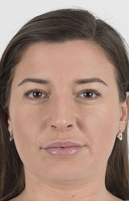 Before Aesthetic Hyaluronic acid lip fillers injectables in Montreal