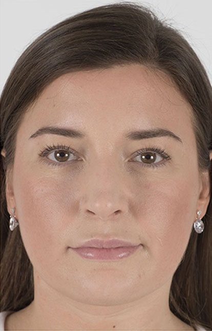 Before Aesthetic Hyaluronic acid lip fillers injectables in Montreal