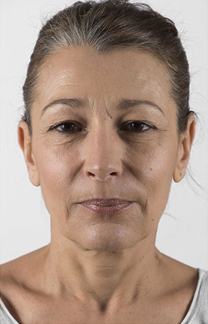 After Aesthetic Hyaluronic acid dermal fillers injectables in Montreal