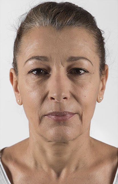 Before Aesthetic Hyaluronic acid dermal fillers injectables in Montreal