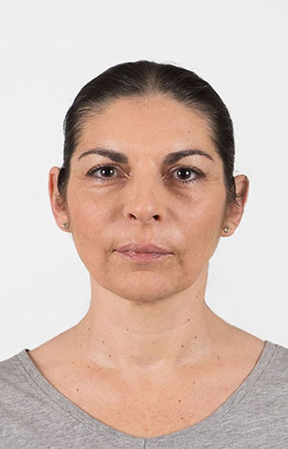 After Aesthetic Hyaluronic acid dermal fillers injectables in Montreal