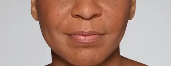 After Aesthetic Hyaluronic acid dermal fillers injectables in Montreal