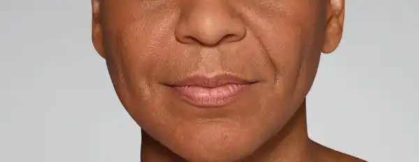 Before Aesthetic Hyaluronic acid dermal fillers injectables in Montreal