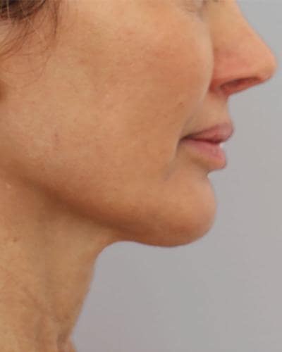 After double chin Profound Radiofrequency Microneedling Skin treatment - Montreal