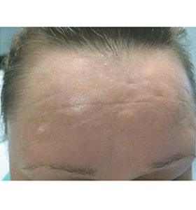 Patient after Scarlet-S RF treatment for burns - Ideal Body Clinic Montreal