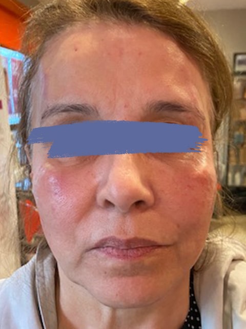 Female jaw and eyebrow after PDO thread lift procedure at our Montreal, Quebec aesthetic clinic