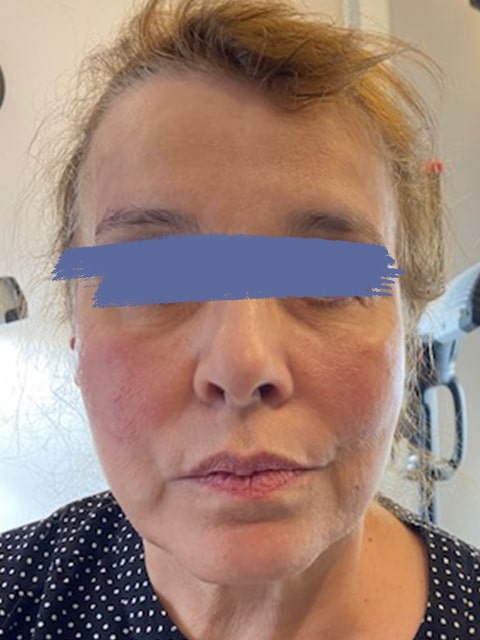 Female jaw and eyebrow before PDO thread lift procedure at our Montreal, Quebec aesthetic clinic