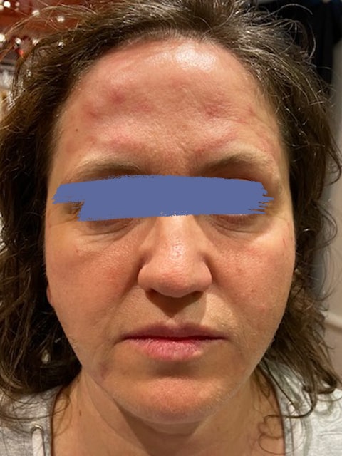 Female marionette lines before PDO thread lift procedure at our Montreal, Quebec aesthetic clinic