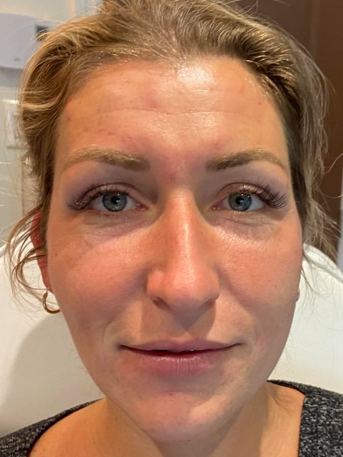 Droopy eyes and jaw before PDO thread lift procedure at our Montreal, Quebec aesthetic clinic