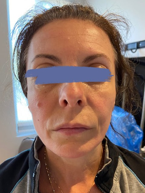After Female jowls lift procedure with PDO threads at our Montreal, Quebec aesthetic clinic