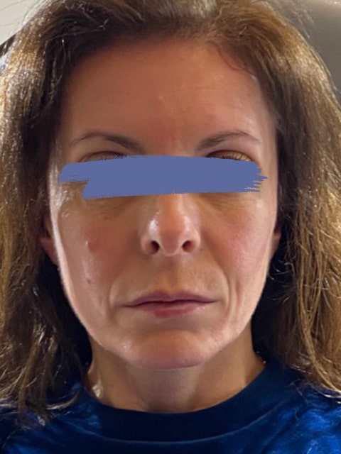 Before Female jowls lift procedure with PDO threads at our Montreal, Quebec aesthetic clinic