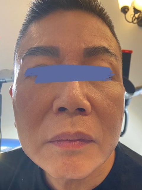 Male chin and jaw before PDO thread lift procedure at our Montreal, Quebec aesthetic clinic