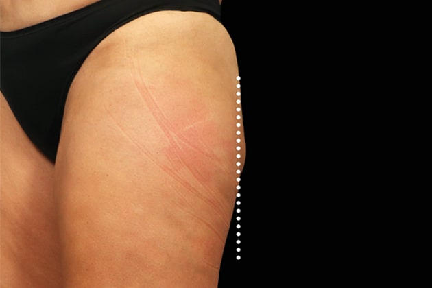 Thigh bulge After Emsculpt NEO Body Contouring fat removal therapy in Montreal