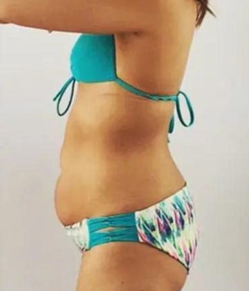 Belly fat Before Slimwave Montreal treatment at Ideal Body Clinic