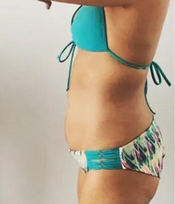 Belly fat After Slimwave Montreal treatment at Ideal Body Clinic