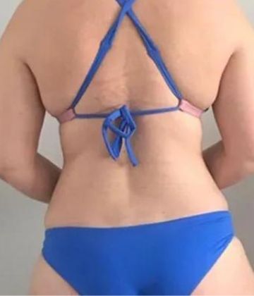 Muffin tops after Slimwave Montreal treatment at Ideal Body Clinic