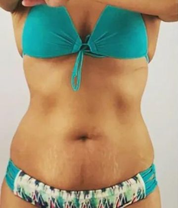 Love handles Before Slimwave Montreal treatment at Ideal Body Clinic