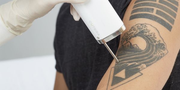 Tattoo Removal Montreal at our Ideal Body Clinic with CUTERA Enlighten