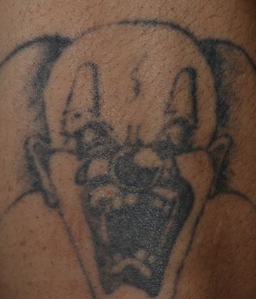 Before CUTERA Enlighten Tatto Removal Montreal