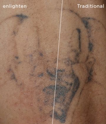 After CUTERA Enlighten Tatto Removal Montreal