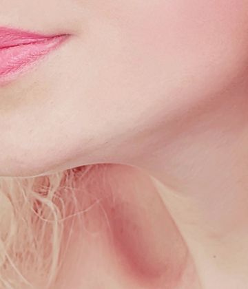 Belkyra double chin treatment in Montreal after picture