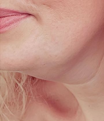 Belkyra double chin treatment in Montreal before picture