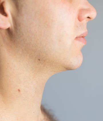 Belkyra Belkyra before and after pictures for double chin in Montreal